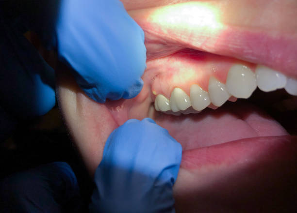 Best Emergency Dentist for Lost Fillings or Crowns in Carlinvle, IL